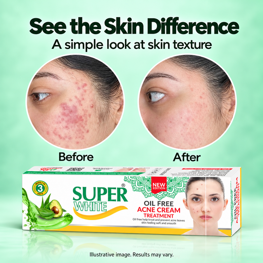 Super White Oil-Free Acne Cream Tube (10g)