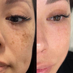 30-Day Freckle Care Kit | Freckle Cream & Rice Collagen Skincare