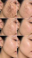 30-Day Freckle Care Kit | Freckle Cream & Rice Collagen Skincare